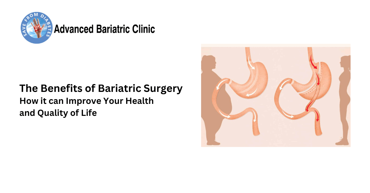 Bariatric Surgery